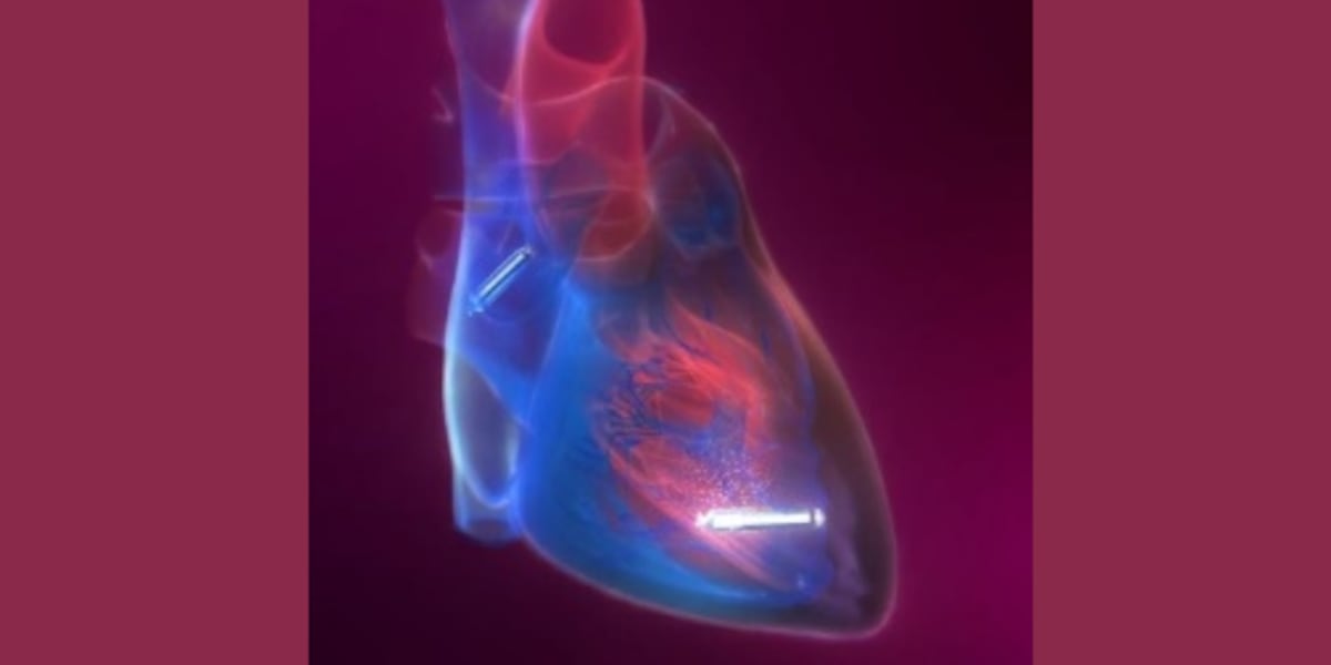 Tiny Tech, Big Relief: Novant Health Pioneers Leadless Pacemaker Implants in South Africa
